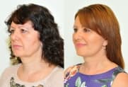 Facelift gallery