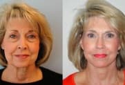 Facelift gallery