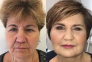 Facelift gallery