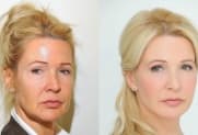 Facelift gallery