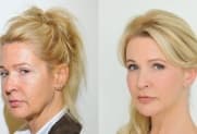 Facelift gallery