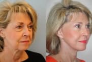 Facelift gallery