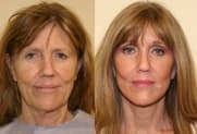 Facelift gallery