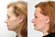 Facelift gallery