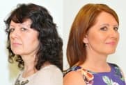 Facelift gallery