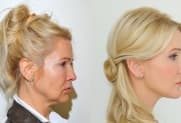 Facelift gallery