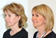 Facelift gallery