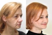 Facelift gallery