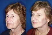 Facelift gallery