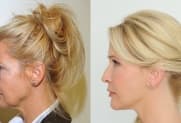 Facelift gallery