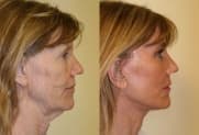 Facelift gallery
