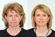 Facelift gallery