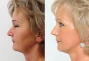 Facelift gallery