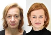 Facelift gallery