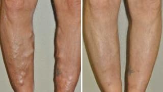 Removal of varicose veins