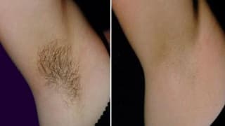 Laser epilation