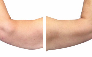Lipotransfer