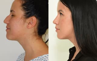 Nose surgery