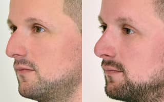 Nose surgery