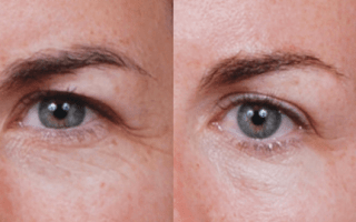Eyelids surgery