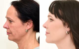 Eyelids surgery