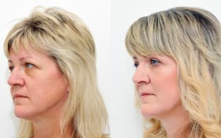 Eyelids surgery