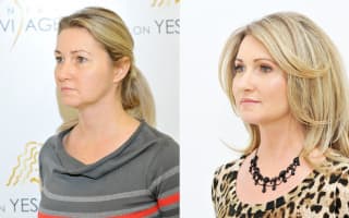 Eyelids surgery