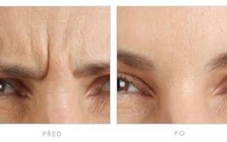 Botox
