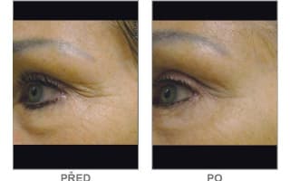 Brow and eyebrows
