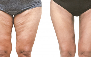 Lipotransfer