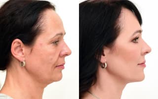 Eyelids surgery