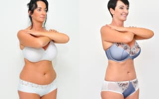 Lipotransfer
