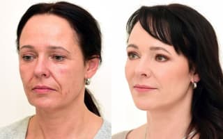 Eyelids surgery