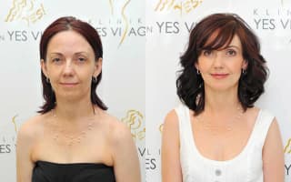 Eyelids surgery
