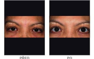 Brow and eyebrows