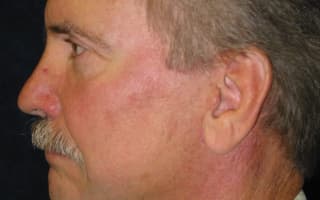 Nose surgery