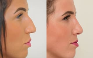 Nose surgery