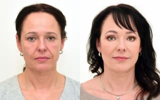 Eyelids surgery