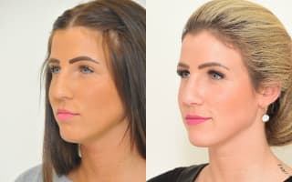 Nose surgery