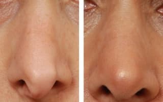 Nose surgery