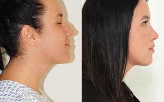 Nose surgery