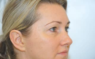 Eyelids surgery