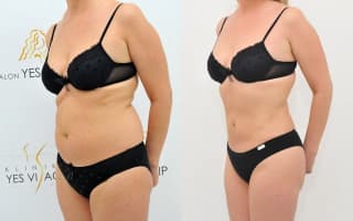 Lipotransfer