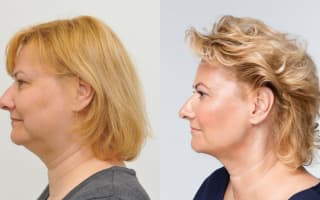 Double chin liposuction