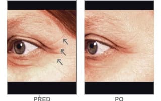 Brow and eyebrows
