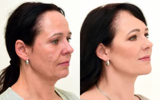 Eyelids surgery
