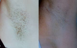 Epilation
