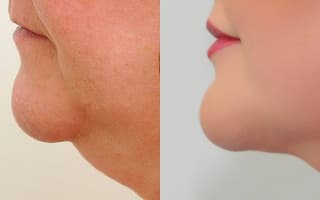 Lipotransfer