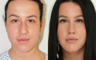 Nose surgery