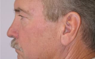Nose surgery